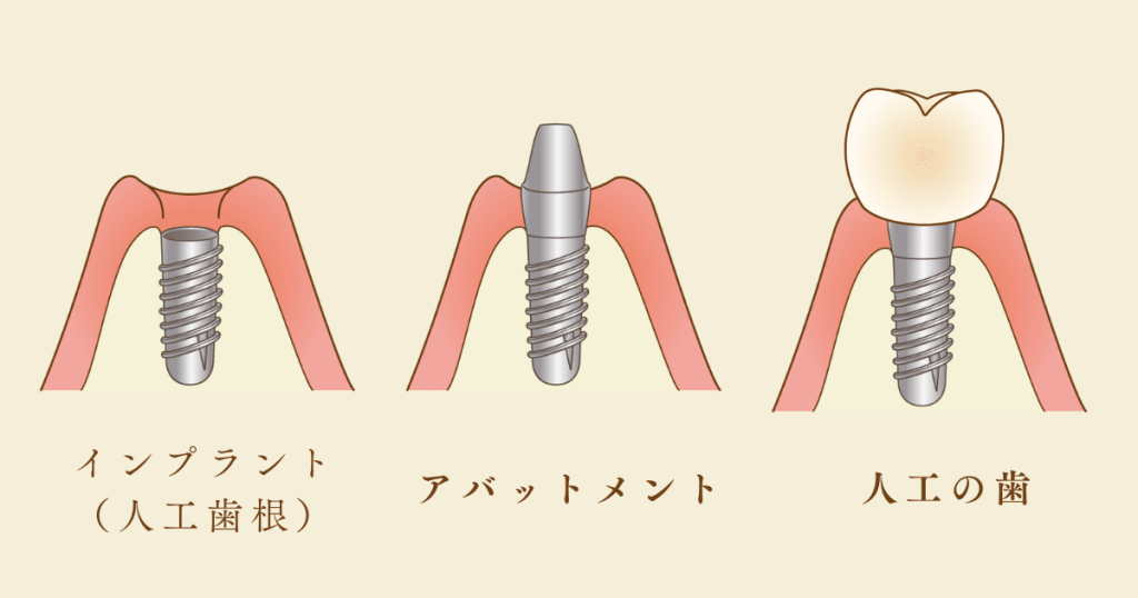 インプラント・アパットメント・人工の歯